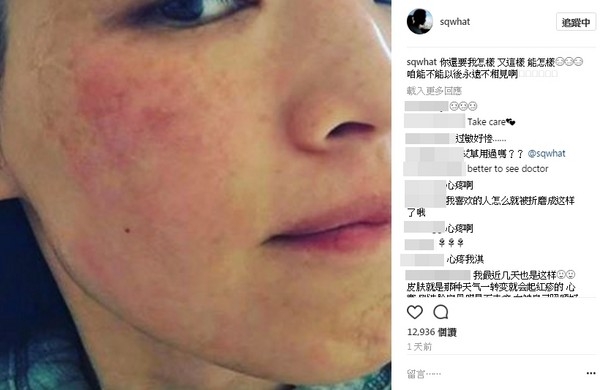 舒淇满脸红疹